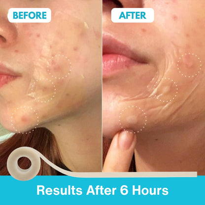 Zyntracosmetics Hydrocolloid Roll